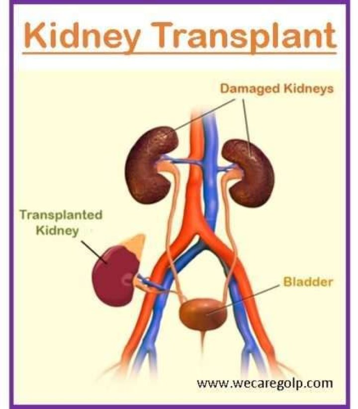 How many years does a kidney transplant last?