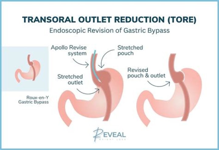 What is the average out of pocket cost for gastric bypass surgery?